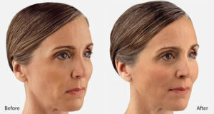 Cheek Filler - Juvederm Voluma XC